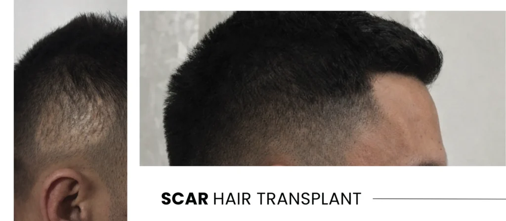 Scar Hair Transplant