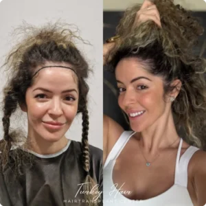 Before &Amp; After Hair Restoration Excellence You Can Trust