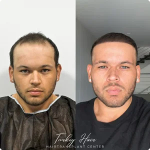 Before &Amp; After Hair Restoration Excellence You Can Trust