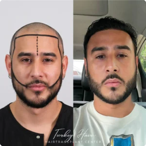 Before &Amp; After Hair Restoration Excellence You Can Trust
