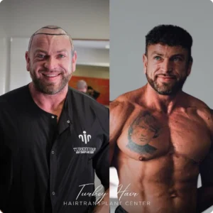 Before &Amp; After Hair Restoration Excellence You Can Trust