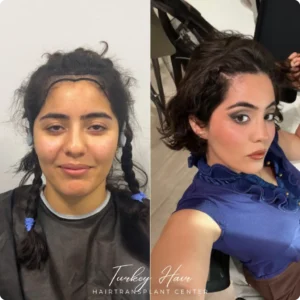 Before &Amp; After Hair Restoration Excellence You Can Trust