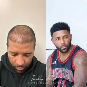 Before &Amp; After Hair Restoration Excellence You Can Trust