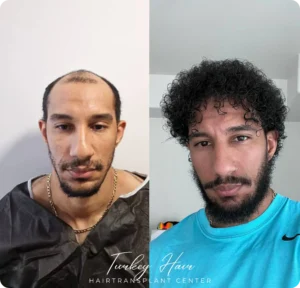 Before &Amp; After Hair Restoration Excellence You Can Trust