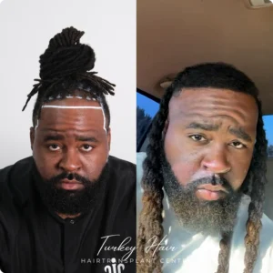 Before &Amp; After Hair Restoration Excellence You Can Trust