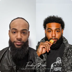 Before &Amp; After Hair Restoration Excellence You Can Trust