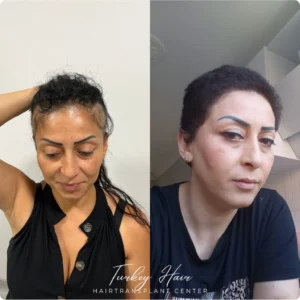 Before &Amp; After Hair Restoration Excellence You Can Trust
