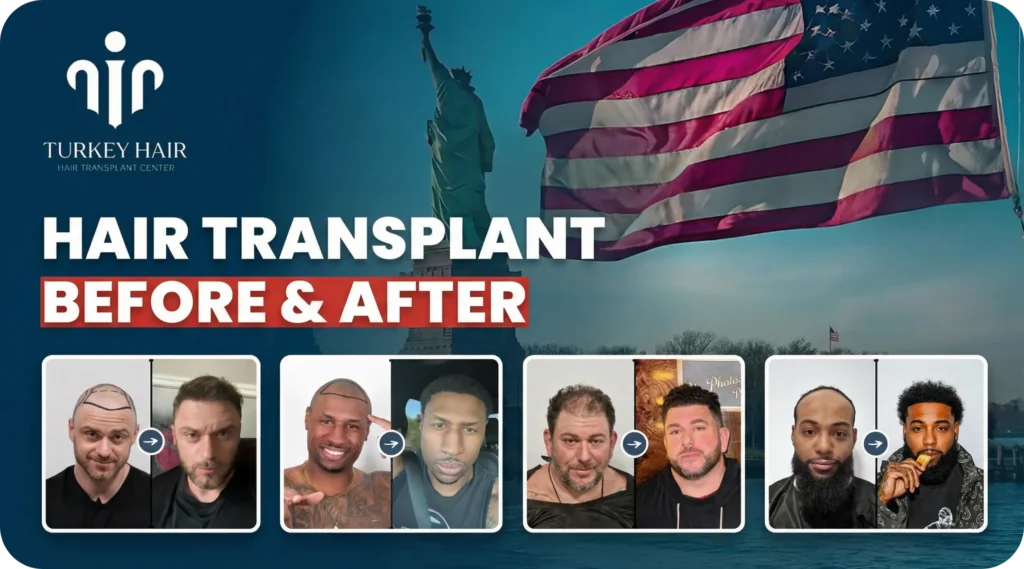 Turkey Hair Transplant Before And After Turkey Hair Transplant Before - After