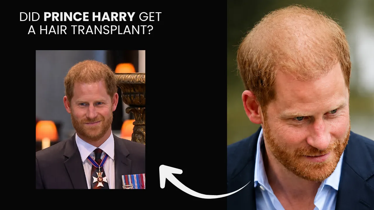 Prince Harry Hair Transplant: Before &Amp;Amp; After, Crown Density Analysis 1 Prince Harry Hair Transplant Comparison Image Showing Visible Crown Thinning And Hair Density Changes Over Time.