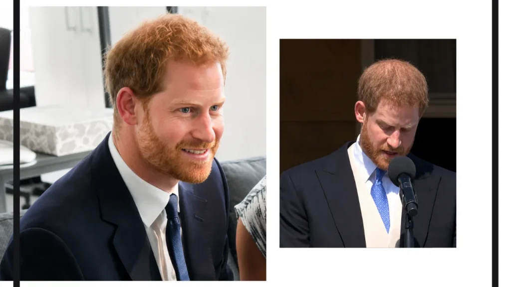 Prince Harry Hair Transplant: Before &Amp; After, Crown Density Analysis 4 Prince Harry Hair Loss Comparison Showing Differences In Crown Density And Thinning Hair During Public Appearances.
