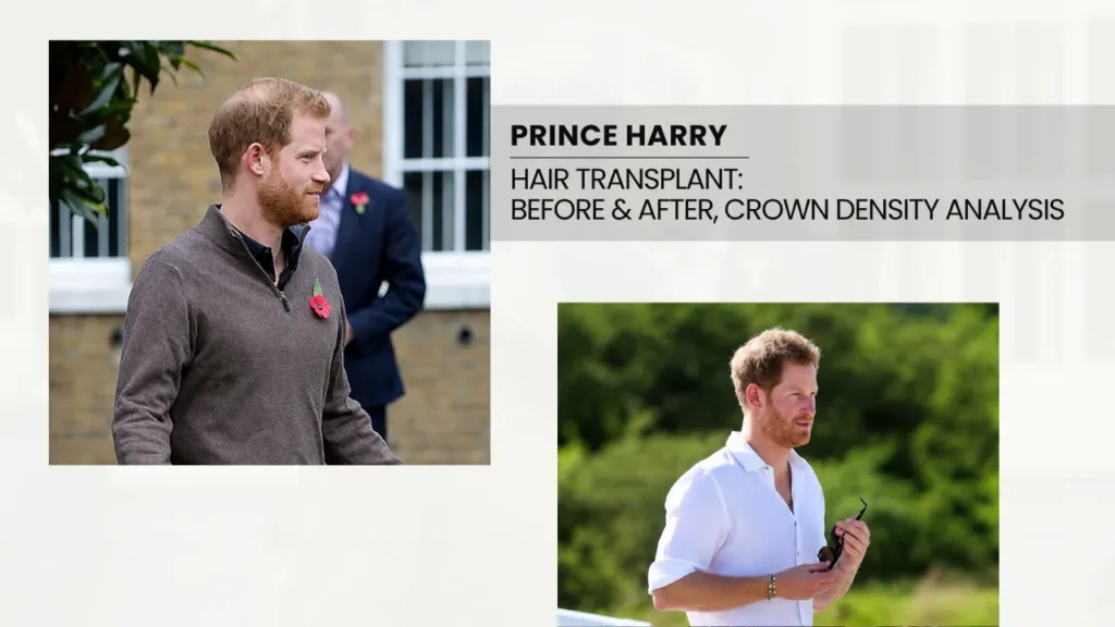 Prince Harry Hair Transplant: Before &Amp; After, Crown Density Analysis 2 Prince Harry Hair Transplant Before And After Comparison Focusing On Crown Density And Visible Hair Thinning Analysis.