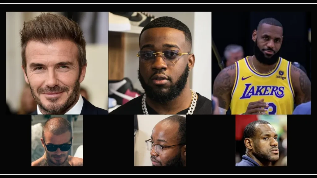 Lebron James, Jidion Ve David Beckham Saç Ekimi Öncesi Ve Sonrası Sonuçlarının Karşılaştırılması