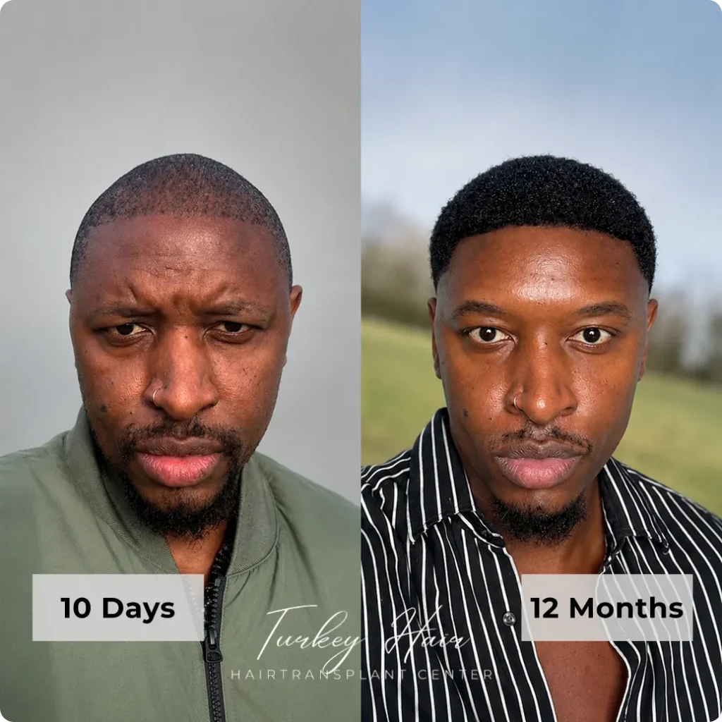 Afro Hair Transplant Before And After: 17 Real 12-Month Results &Amp; Expert Analysis Hair Restoration Excellence You Can Trust