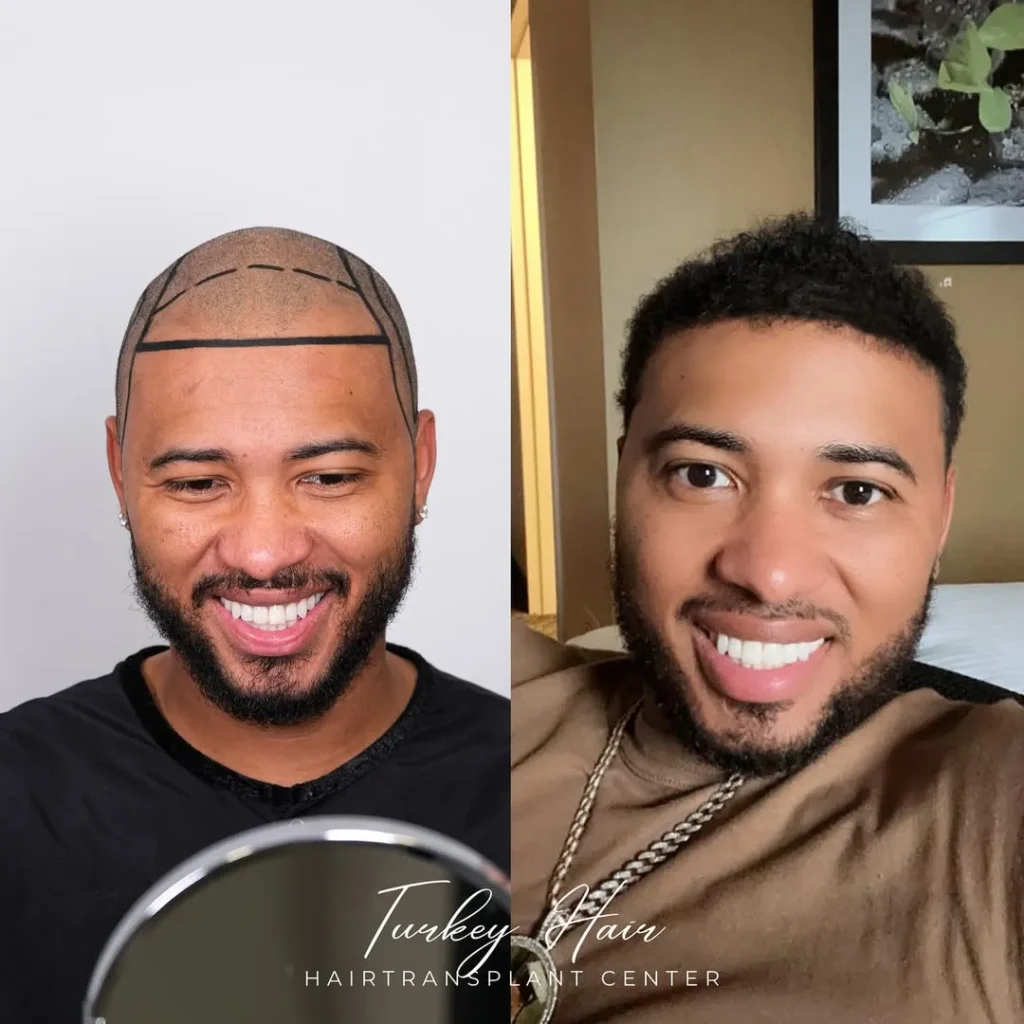 Afro Hair Transplant Before And After: 17 Real 12-Month Results &Amp; Expert Analysis Hair Restoration Excellence You Can Trust