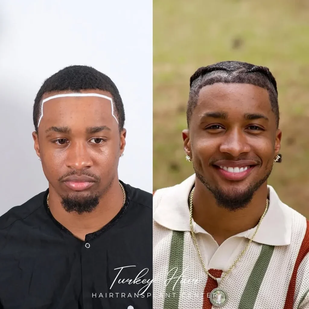 Afro Hair Transplant Before And After: 17 Real 12-Month Results &Amp; Expert Analysis Hair Restoration Excellence You Can Trust