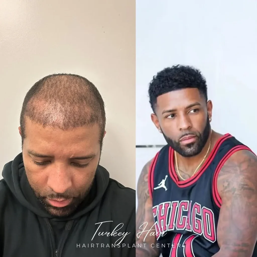 Afro Hair Transplant Before And After: 17 Real 12-Month Results &Amp; Expert Analysis Hair Restoration Excellence You Can Trust