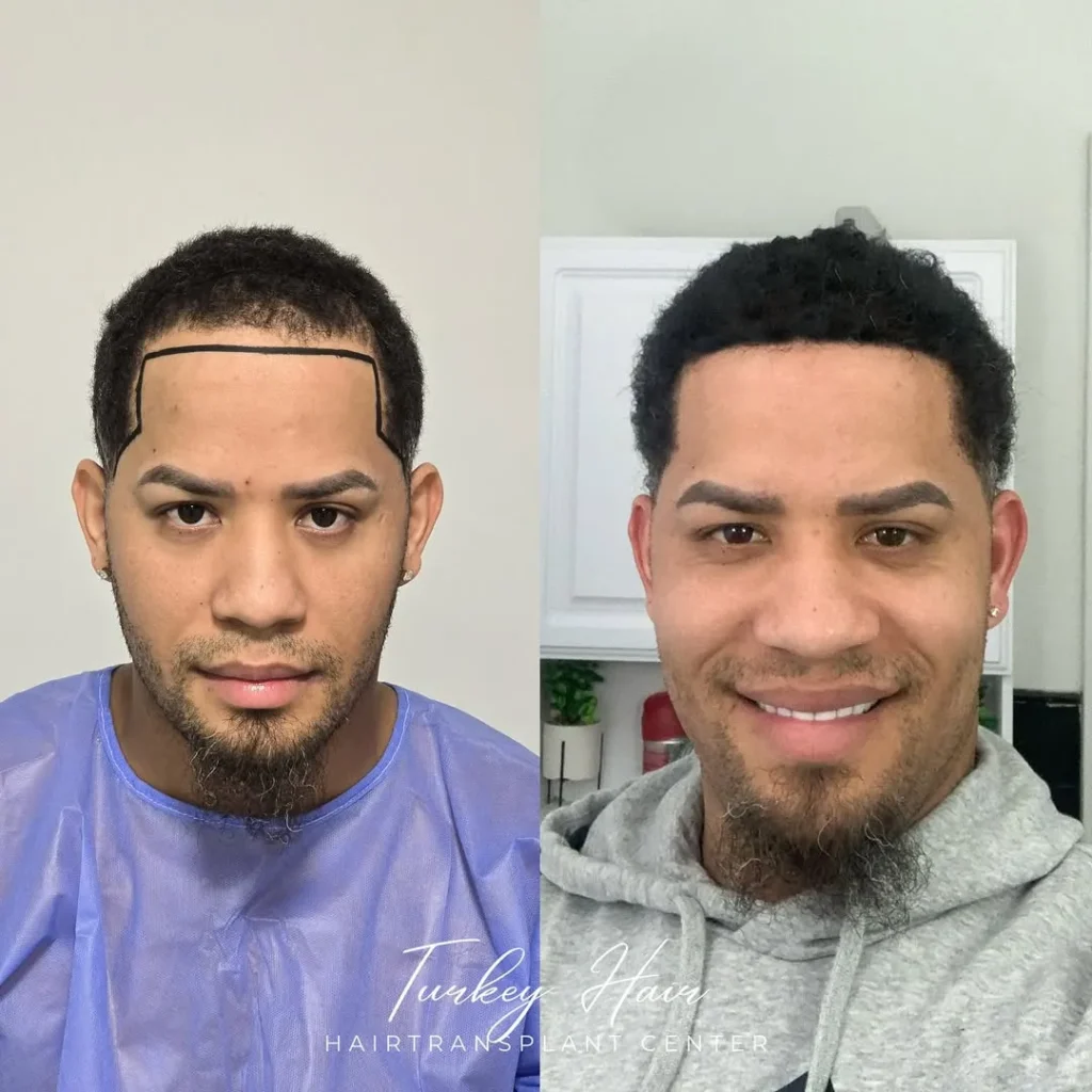 Afro Hair Transplant Before And After: 17 Real 12-Month Results &Amp; Expert Analysis Hair Restoration Excellence You Can Trust