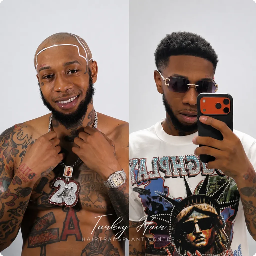 Afro Hair Transplant Before And After: 17 Real 12-Month Results &Amp; Expert Analysis Hair Restoration Excellence You Can Trust