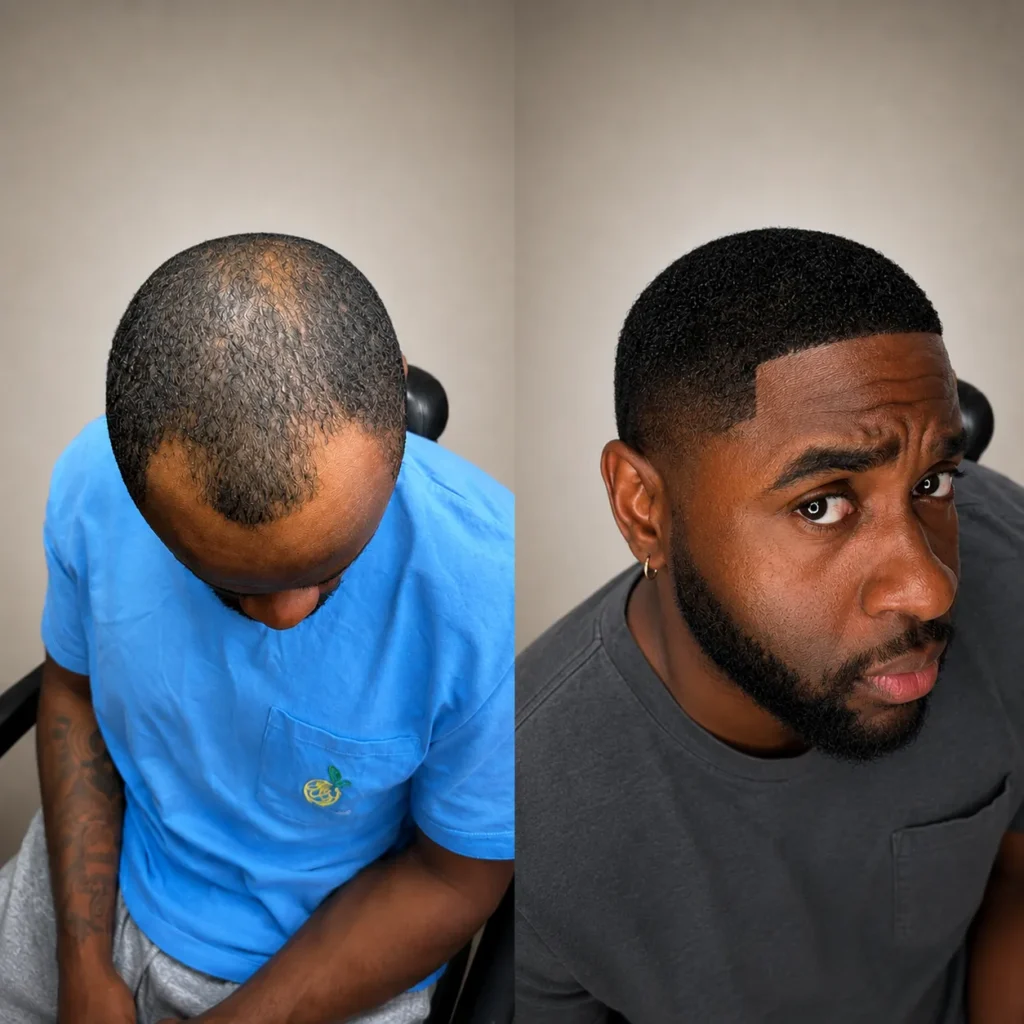 Afro Hair Transplant Before And After: 17 Real 12-Month Results &Amp; Expert Analysis Hair Restoration Excellence You Can Trust