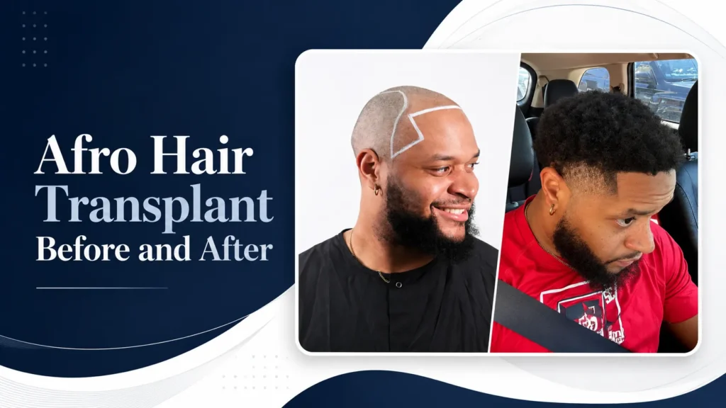 Afro Hair Transplant Before And After