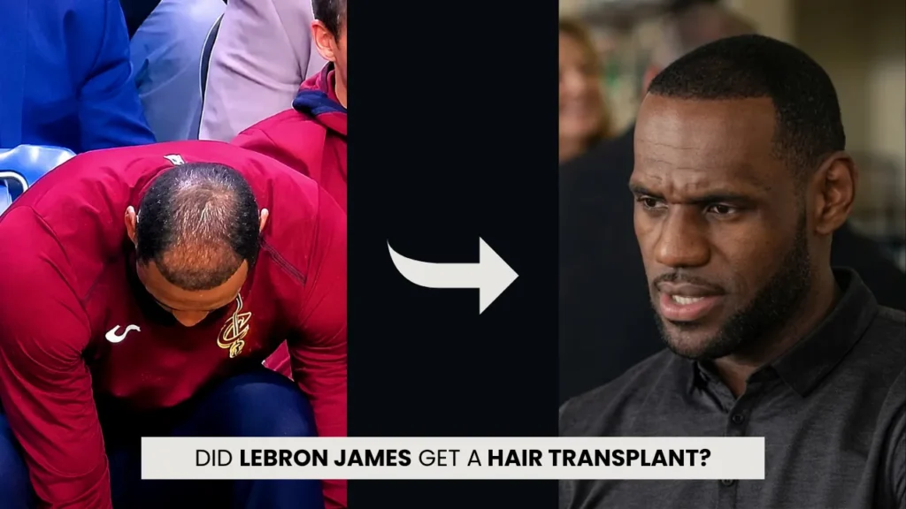 Lebron James Hair Transplant Before And After Hairline Comparison Showing Visible Thinning And Fuller Later Hairline