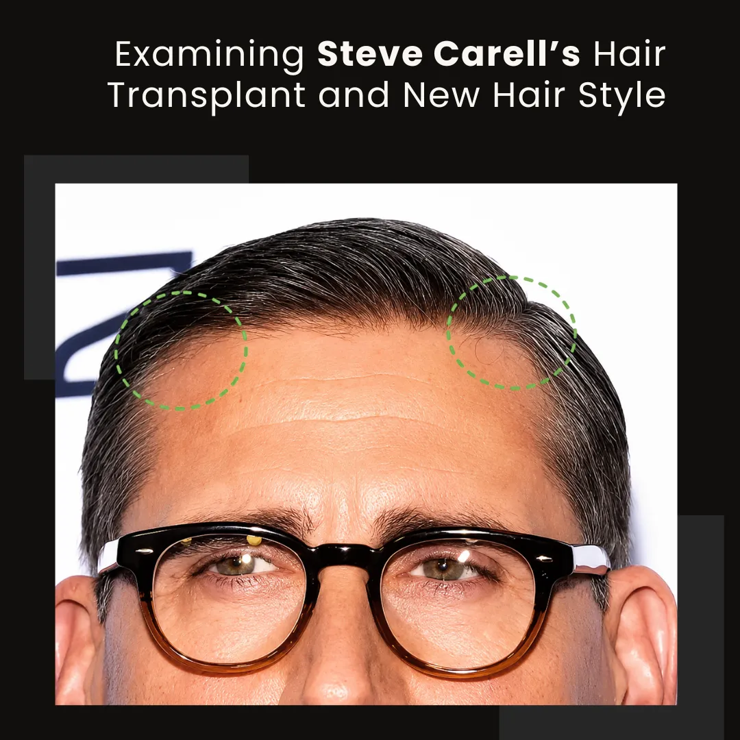 Steve Carell Hairline Analysis And New Hair Style Steve Carell Hairline Analysis Showing Temple Areas And Possible Hair Restoration Signs