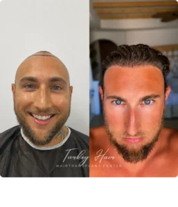 Hair Transplant Before And After Transformation Showing Natural Hairline Restoration And Improved Density