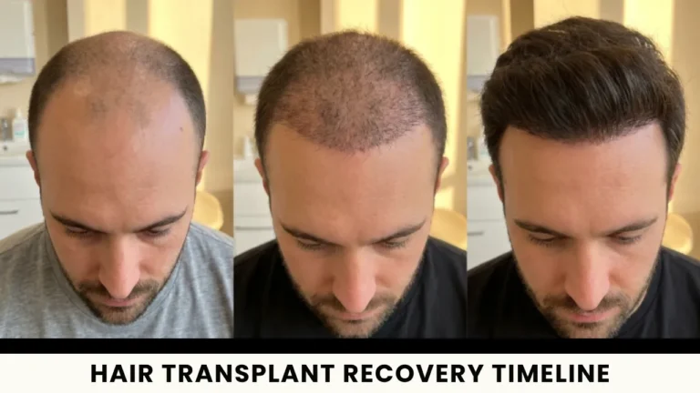 Hair Transplant Recovery Timeline Cover Image Showing Hair Growth Progress From Thinning Hair To Fuller Density After Restoration