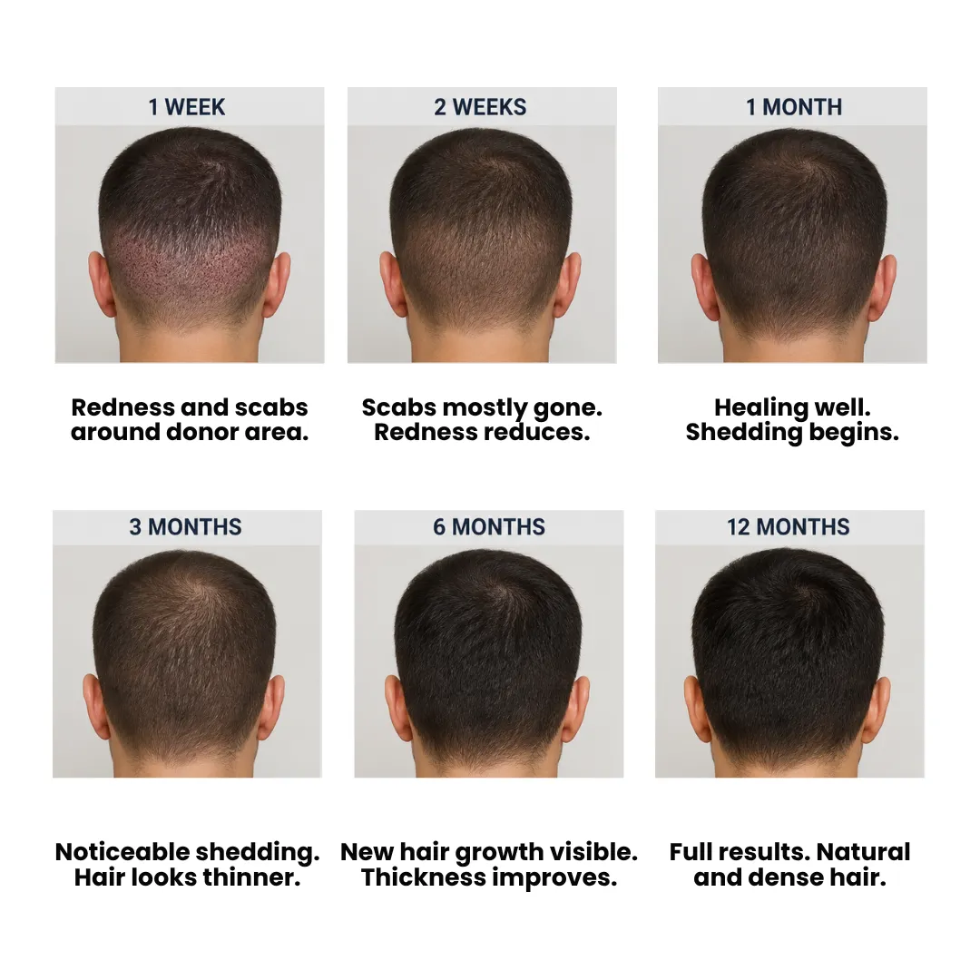 Hair Transplant Recovery Timeline Showing Donor Area Healing From 1 Week To 12 Months With Scabs, Shedding, New Growth, And Final Results