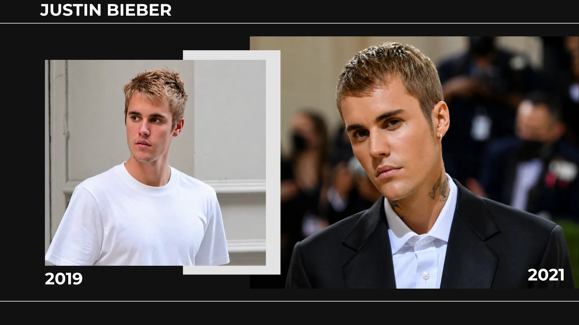 Justin Bieber Hair Transplant: Hairline Analysis, Before &Amp; After Photos, Rumors &Amp; Expert Opinion 7 Justin Bieber 2019 And 2021 Hairline Comparison Showing Hairstyle, Forehead Visibility, And Frontal Hair Coverage Changes
