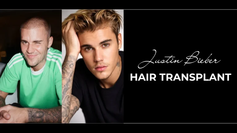 Justin Bieber Hair Transplant Cover Image Showing Buzz Cut And Fuller Hairstyle Comparison For Hairline Analysis