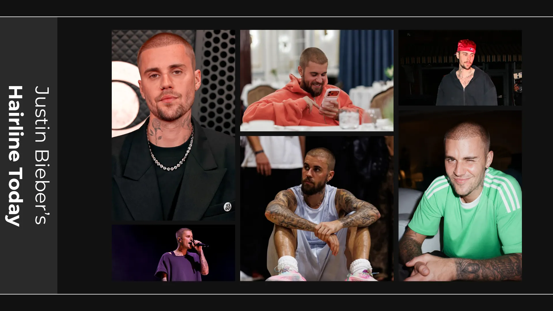Justin Bieber Hair Transplant: Hairline Analysis, Before &Amp; After Photos, Rumors &Amp; Expert Opinion 3 Justin Bieber Hairline Today Collage Showing Buzz Cut Hairstyle, Current Hair Density, And Frontal Hairline Appearance