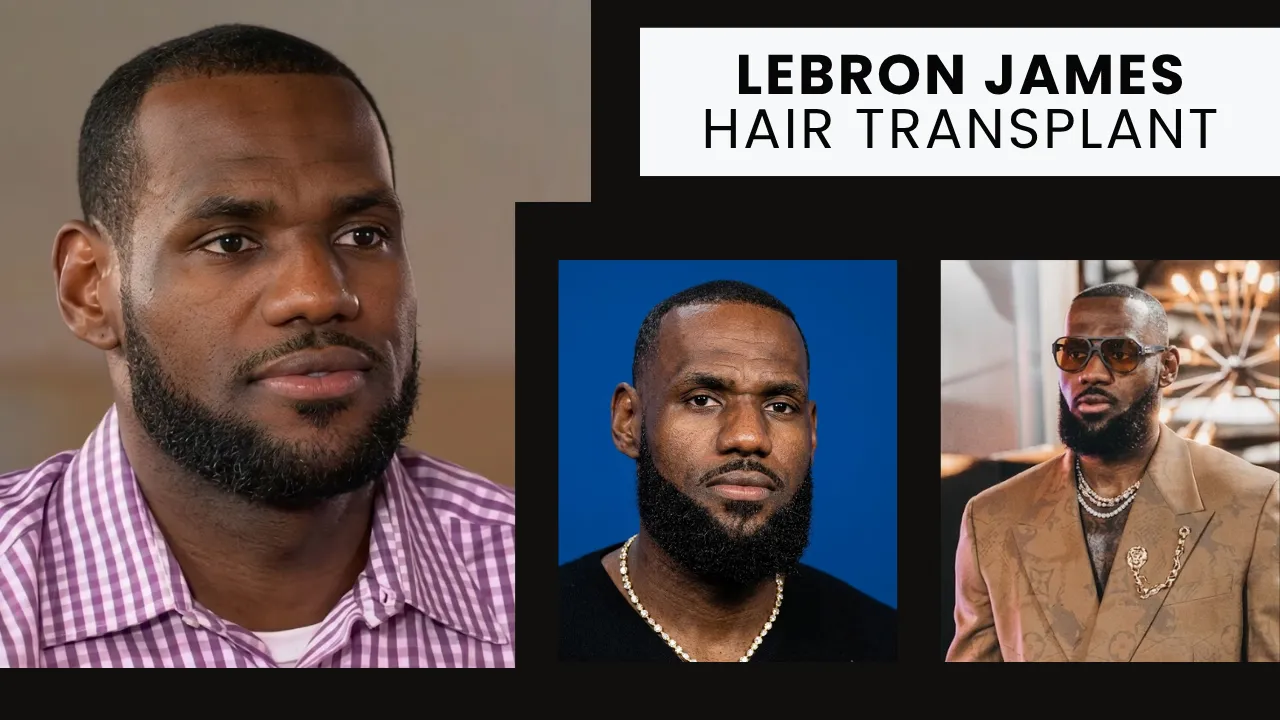 Lebron James Hair Transplant Visual Analysis Showing Hairline Changes Across Different Years