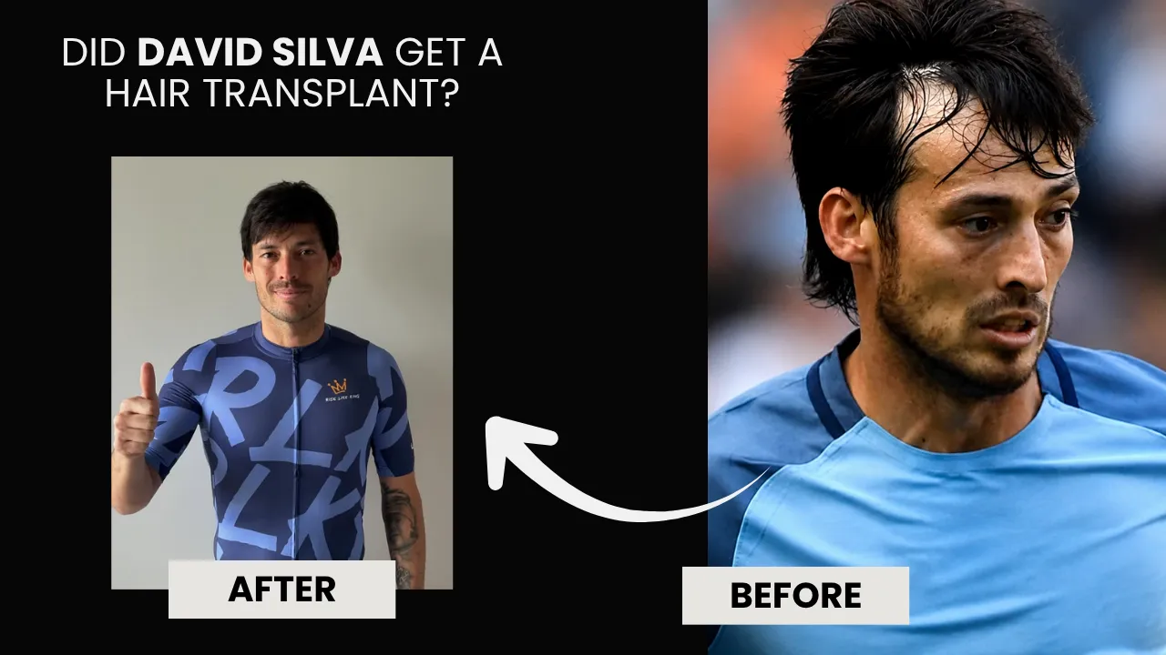 David-Silva-Hair-Transplant-Analysis.webp David Silva Hair Transplant Before And After Comparison Showing Improved Hairline Density And Frontal Restoration