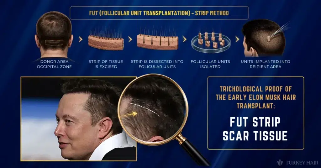 Elon Musk hair transplant scar analysis comparing FUT strip scar tissue and possible transplant technique