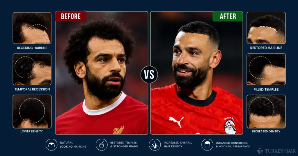 mohamed salah hair transplant before after, mohamed salah hair transplant results, did mohamed salah have a hair transplant, mohamed salah hairline restoration, temple recession treatment, celebrity hair transplant before after, hair density improvement