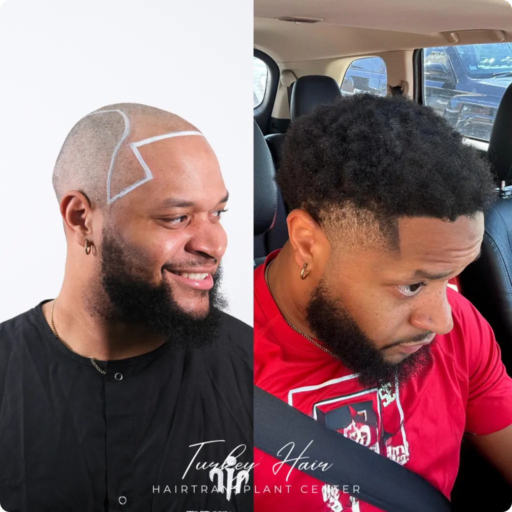 Afro hair transplant before and after result showing natural hairline restoration in Turkey